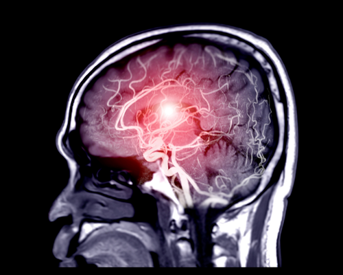 Neuro Surgery